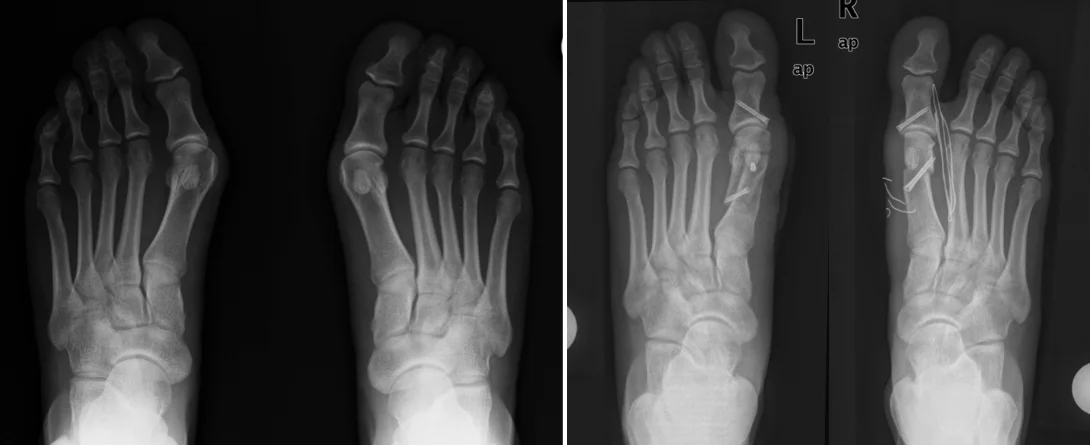 halluks_valgus.webp