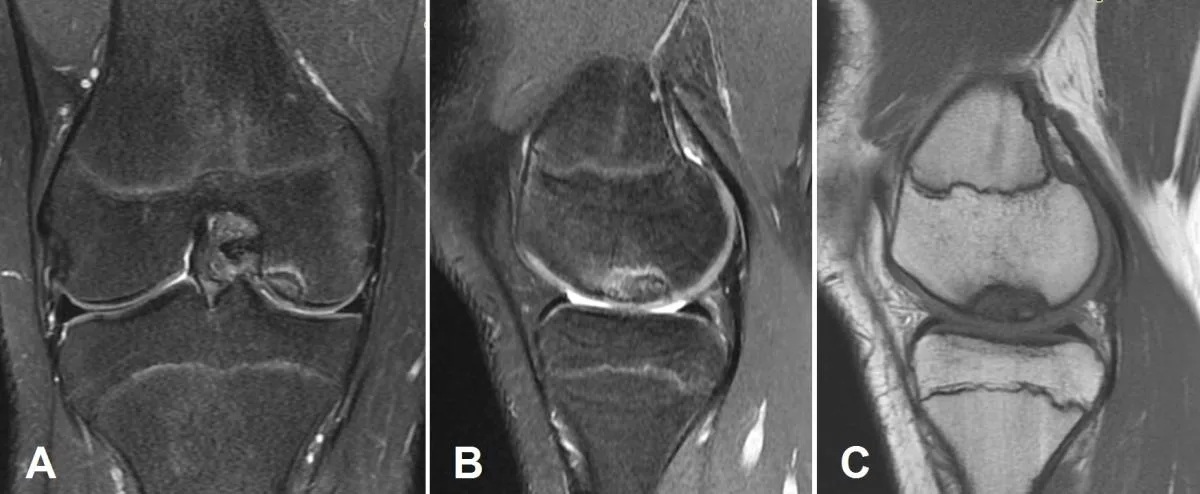 Follow-up MRI 3 months