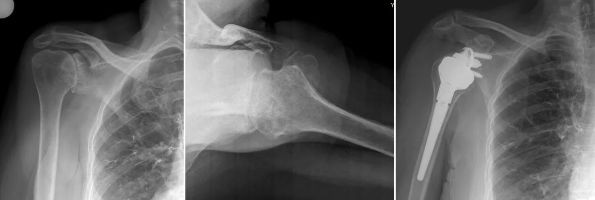 omuz_protezi_reverse_shoulder.webp