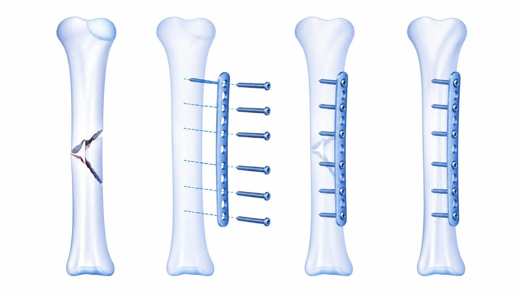 Orthopedic Trauma Surgery