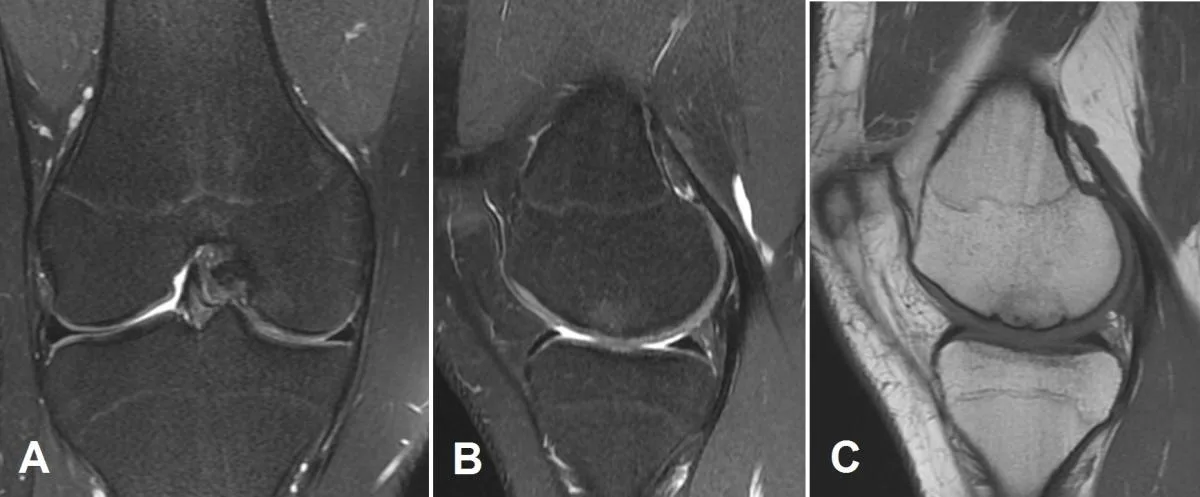 Knee cartilage defect MRI