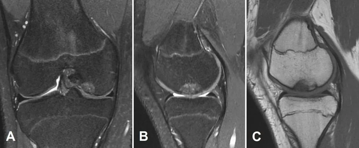 Follow-up MRI 18 months