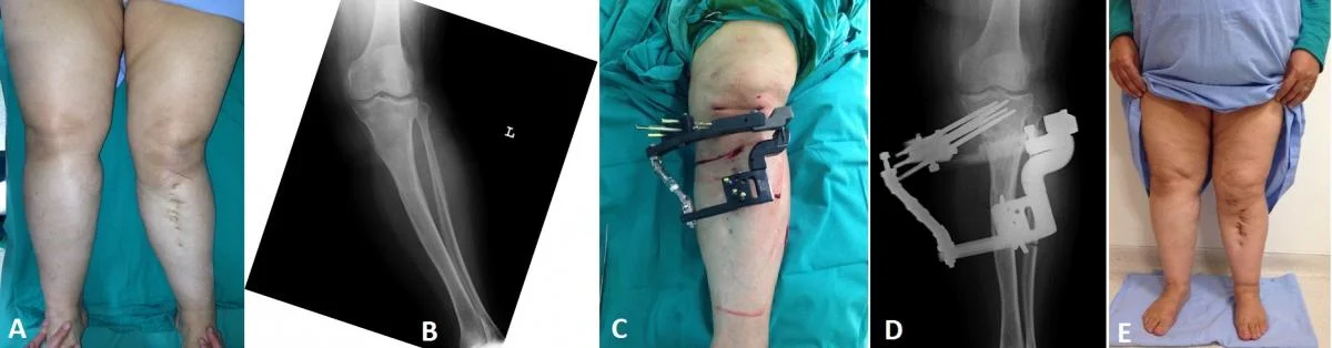 tibia_deformite_2.webp