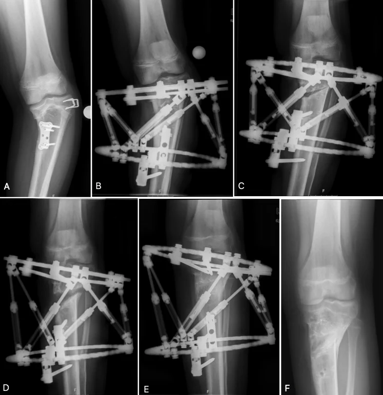 tibia_deformite.webp