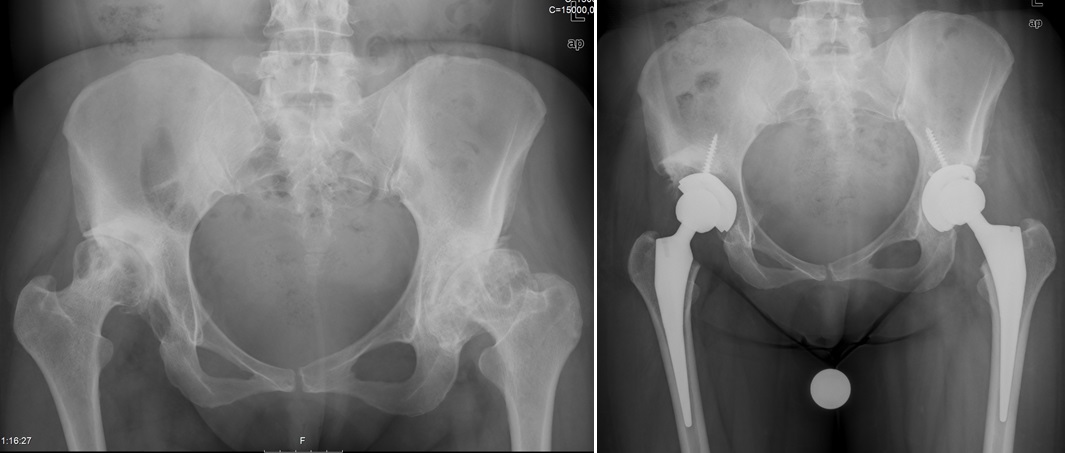 Gelişimsel kalça displazisi (doğuştan kalça çıkığı) zemininde gelişmiş kalça kireçlenmesi olan bir olguda ameliyat öncesi ve sonrası radyografiler