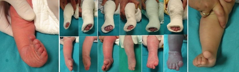 3 günlük bir kız bebeğin sağ ayağındaki doğuştan çarpık ayak (pes equinovarus - PEV) deformitesine yönelik uygulanmış alçı tedavisi