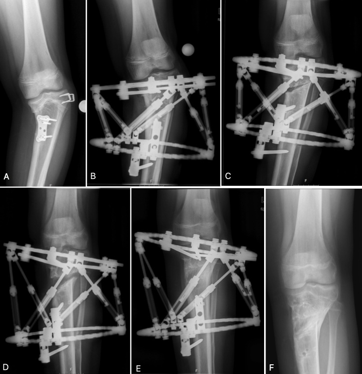 Bacak kemiğinde (tibia) orta hatta doğru dönüklük (varus) deformitesi olan 14 yaşındaki bir olguda bilgisayar destekli eksternal fiksatör sistemi ile gerçekleştirilmiş düzeltme cerrahisi (alfabetik sıraya göre takip ediniz) 